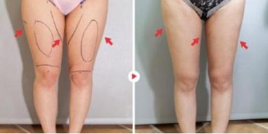 常州哪家醫(yī)院做玻尿酸效果好？