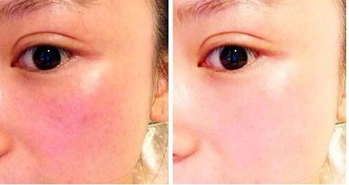 東莞鼻整形專家薈萃！治療頑固鼻部問題有招！