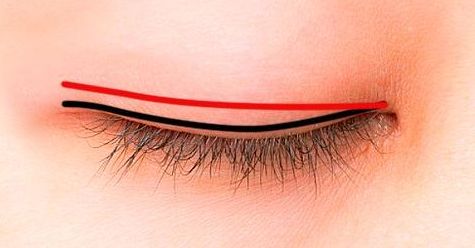 曹衛(wèi)剛修復雙眼皮技藝優(yōu)異，想知道他的專長嘛？進來看看吧！