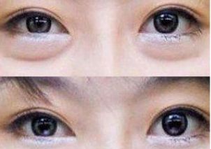 朝陽區(qū)雙眼皮手術(shù)就找TA！專家力推朝陽二醫(yī)院頂級雙眼皮醫(yī)生