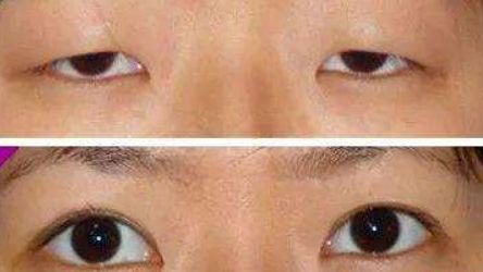 金華麗都整形為您呈現(xiàn)：雙眼皮神奇案例揭秘，專家力薦！