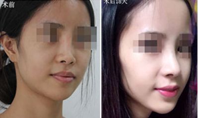 深圳哪家醫(yī)院隆胸效果好？排名前五火熱推薦！