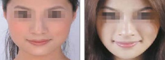 2024年適合自體豐胸的沈陽醫(yī)院有哪些好選擇？