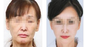 廣州最好的抽脂醫(yī)院選哪家