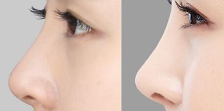 廣州隆胸修復(fù)有哪些值得信賴的醫(yī)院？豐滿胸部是否真的可行？