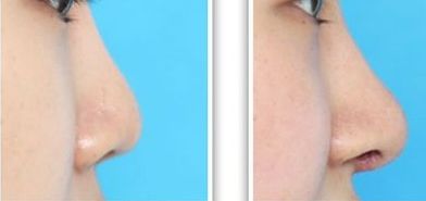 北京亞楠容悅：蔣亞楠醫(yī)生鼻基底抬高，塑造精致面容