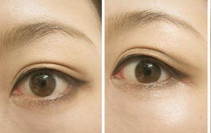 沈燕華醫(yī)生雙眼皮技術(shù)值得信賴，術(shù)后效果受到患者一致好評(píng)！