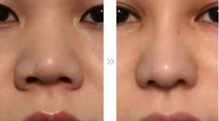 哪位醫(yī)生在全國(guó)范圍內(nèi)的脂肪填充領(lǐng)域技術(shù)比較好？