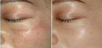 中國醫(yī)院雙眼皮修復技術(shù)，2023新晉熱門曝光！