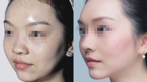 臺(tái)州哪家醫(yī)院治療乳頭矯正效果好？