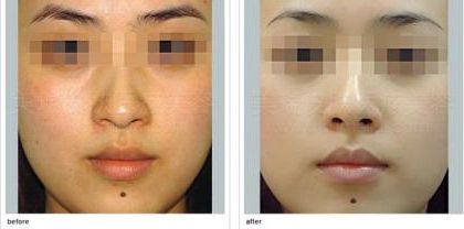 臺州狐臭治療中哪家醫(yī)院效果好？