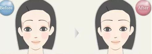 浙江哪家醫(yī)院眼袋祛除效果好？