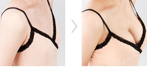 三明市第二醫(yī)院重磅推薦：陳國(guó)章醫(yī)生絕佳雙眼皮+內(nèi)眼角完美案例！