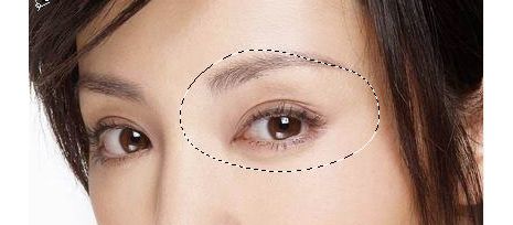 西安哪家醫(yī)院治療上瞼下垂價格合適？名醫(yī)推薦+費用咨詢