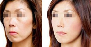 果酸祛痘間隔多久做一次？效果不明顯怎么辦？