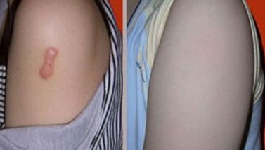 廣州天姿整形醫(yī)院，鼻部整形效果曝光，看看這次個(gè)案如何！