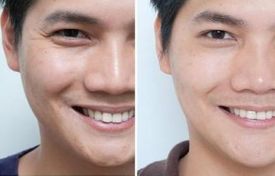 磨骨手術(shù)：價格差異與影響因素