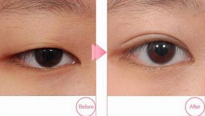 青島市立醫(yī)院雙眼皮割哪位醫(yī)生技術(shù)精湛？附案例和價(jià)格表參考