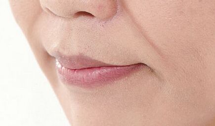 長沙愛思特整形醫(yī)院張嬌嬌修復(fù)案例及醫(yī)生簡介報告