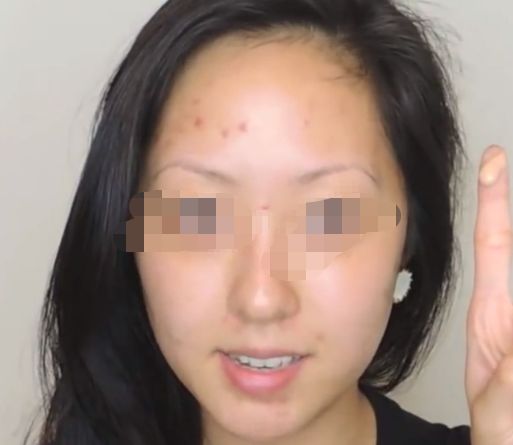 東莞哪家醫(yī)院做玻尿酸好