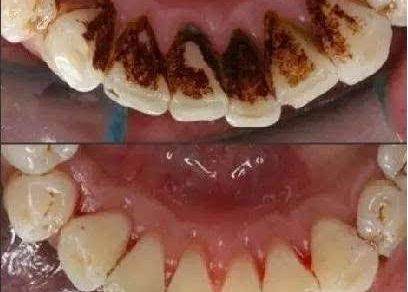 李雪陽分享術(shù)后效果，想看雙眼皮圖片嗎？