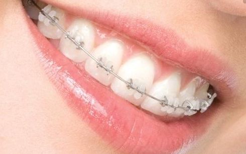 長(zhǎng)沙瑞瀾李增產(chǎn)雙眼皮效果揭曉，2023最新案例揭露