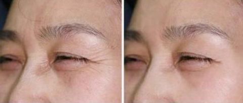 長沙菲瀾整形醫(yī)院醫(yī)生名冊揭曉｜雙眼皮整形案例分享 + 價格一覽