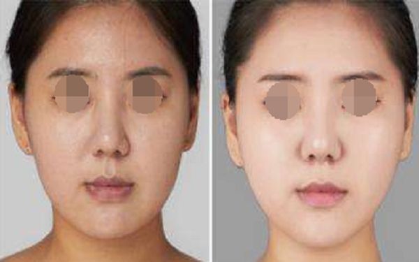 西安整形醫(yī)院的磨骨技術(shù)有哪些優(yōu)點(diǎn)？