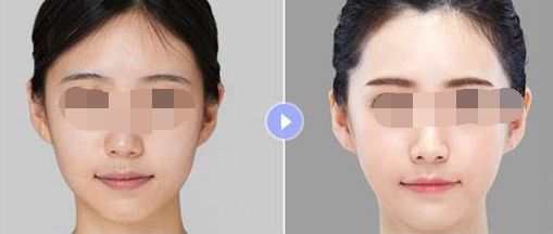 廣州哪家隆胸整形醫(yī)院好？排名大揭曉！