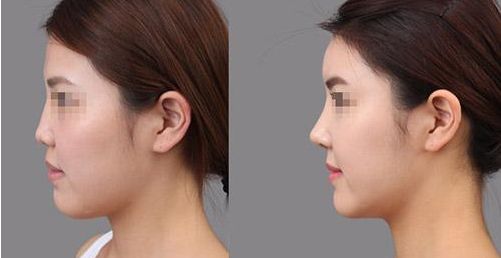 鄭州割雙眼皮醫(yī)院排名榜單揭曉，東方、華山等機(jī)構(gòu)躋身前十強(qiáng)！