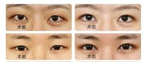 菲塑美減肥針：效果評(píng)估、價(jià)格和潛在風(fēng)險(xiǎn)全解析