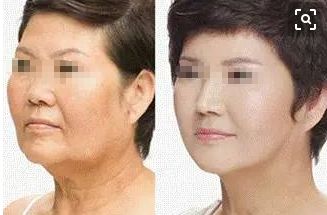 成都去痣名醫(yī)推薦，排行榜前五名有誰？