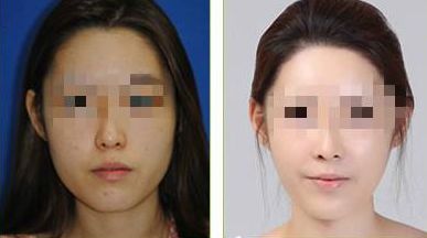 北京潤(rùn)美玉之光脂肪填充測(cè)評(píng)：真實(shí)案例分享，效果與成活率分析