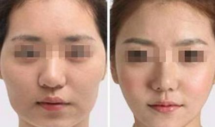 揭秘北京東方和諧脂肪填充真容，真實案例展示精湛技藝！