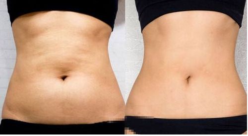 上海葉麗萍醫(yī)生進(jìn)行鼻部整形效果如何？最新成功案例曝光