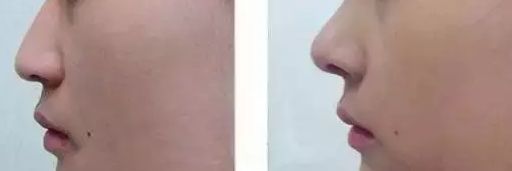 梁曉健隆鼻手術(shù)結(jié)果及費用詳細解析