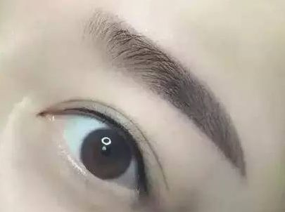 蘇州圣愛醫(yī)院整形科：90天變化揭示，雙眼皮驚喜盡顯！