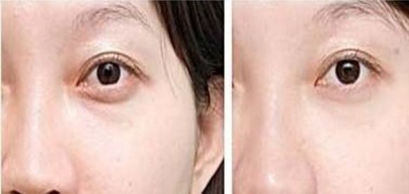 華北地區(qū)顴骨內(nèi)推降低手術(shù)的專業(yè)醫(yī)院醫(yī)生推薦