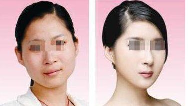 大連附屬二院美容科恢復(fù)效果實(shí)拍，價(jià)格揭秘