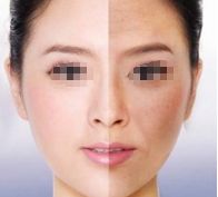 劉志剛醫(yī)生雙眼皮手術(shù)效果怎么樣？