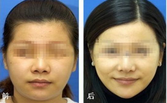 銀川哪家醫(yī)院磨骨整形效果好？