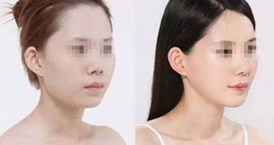 石家莊哪家整形醫(yī)院在隆鼻方面有口碑？