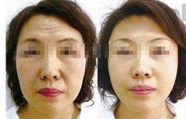 四川人民醫(yī)院王佳醫(yī)生提供下頜角整形案例，讓你輕松擁有小V臉