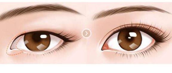 肖海濤的雙眼皮割成效如何？獨(dú)特技術(shù)吸引圈粉！