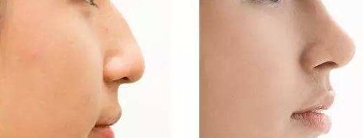 【2023】成都八大處田孝臣隆鼻案例揭秘，鼻部改善效果大躍進(jìn)！