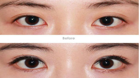 河南省中醫(yī)院整形科是吳盤紅、馬垟垟實力展示嗎？整形效果如何？