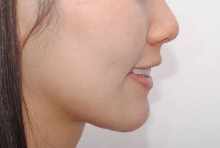 溫醫(yī)大附二院整形科鼻綜合修復(fù)效果可信賴嗎？徐海艇醫(yī)生的豐富經(jīng)驗是否值得信賴呢？