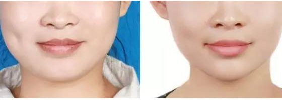 吉林梁一國醫(yī)生為您呈現(xiàn)神奇雙眼皮手術！2023親身經(jīng)歷分享