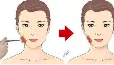 高效祛除眼袋的空軍醫(yī)院腫眼泡治療，看看效果如何？