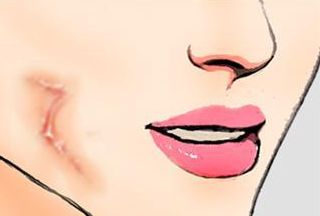 三亞心夢醫(yī)學劉濤醫(yī)生揭秘，無創(chuàng)吸脂實踐案例分享及收費解析！